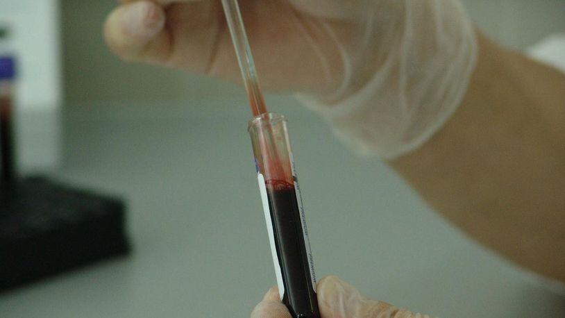 Lab testing of a blood sample is pictured here.