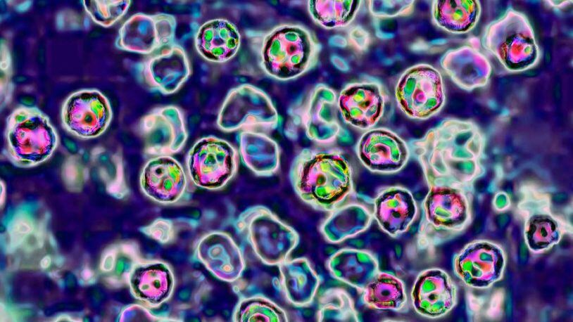 The measles virus, paramyxoviridae from the Morbillivirus family, seen under a microscope.