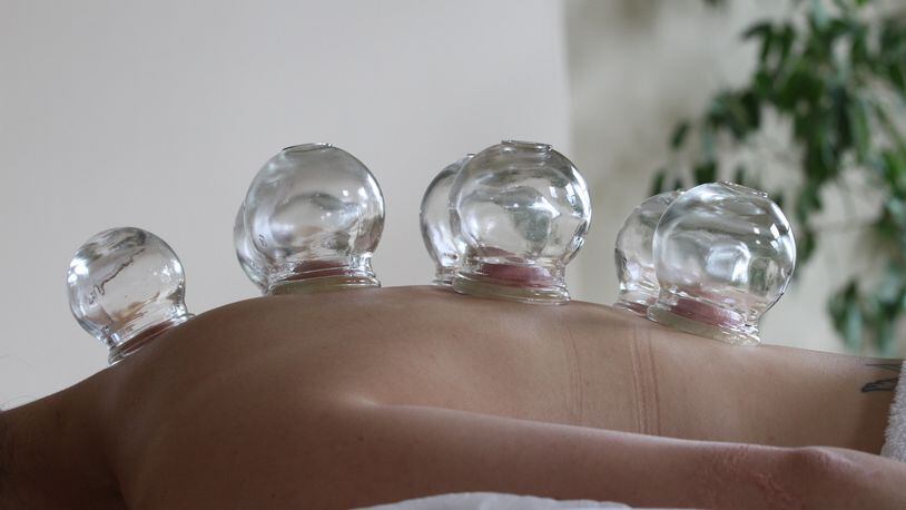 Dr. Xu Hua Han displays  the treatment of cupping on a colleague at a treatment centre in London Wednesday, Aug. 10 2016. Cupping is an ancient method of traditional Chinese medicine, where heat or suction creates a vacuum in glass cups that are placed on the skin of the patient. Athletes at the Rio Olympics have thrust the treatment into the spotlight by displaying large purple and red circles from cupping on their skin.  (AP Photo/Leonora Beck)